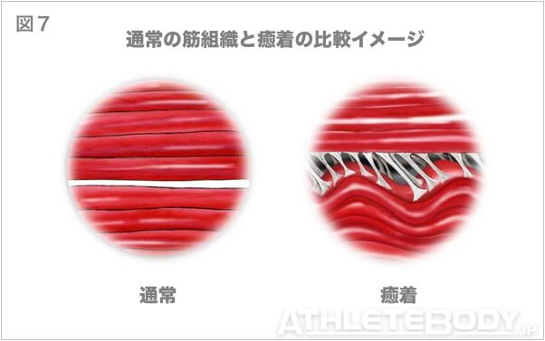 図7 通常の筋組織と癒着の比較イメージ AthleteBody.jp